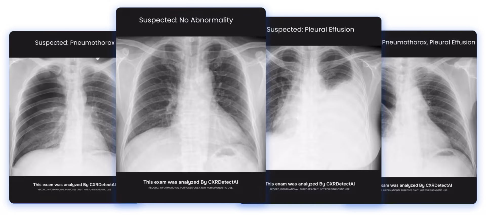 CXRDetectAI, chest X-ray abnormality and TB detection
