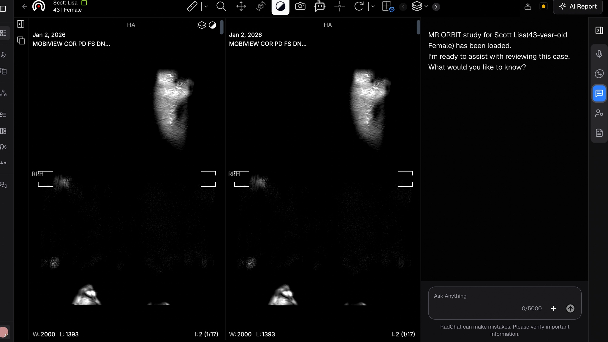 RadChat within AI Viewer